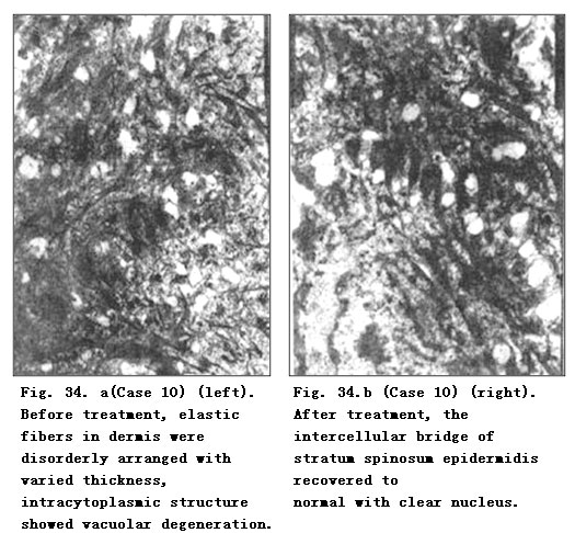 9170金沙集团_Pathomorphological Changes of Deep Burns Wounds Treated with