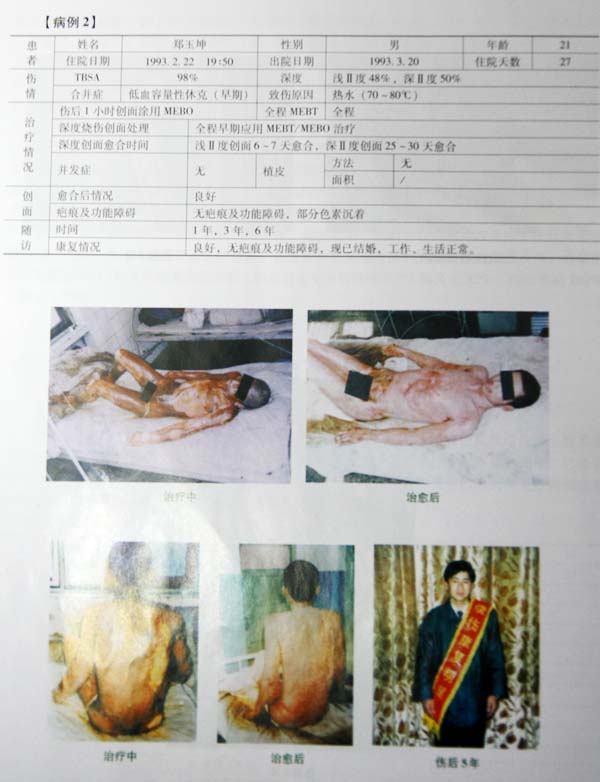 9170金沙集团_第五节 烧伤皮肤系统再生治疗手艺病例先容
