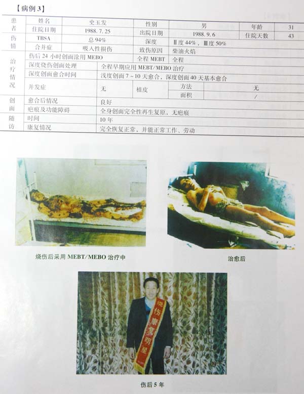 9170金沙集团_第五节 烧伤皮肤系统再生治疗手艺病例先容