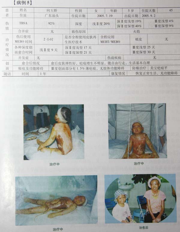 9170金沙集团_第五节 烧伤皮肤系统再生治疗手艺病例先容
