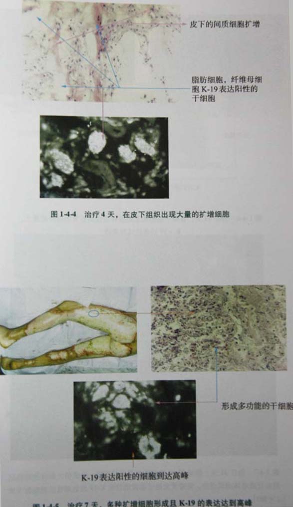 9170金沙集团_第二节 四肢热挤压伤治疗手艺