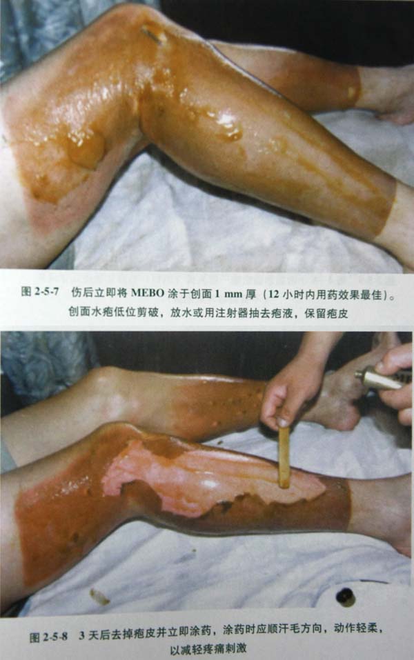 9170金沙集团_第二节 表皮深层损伤治疗手艺