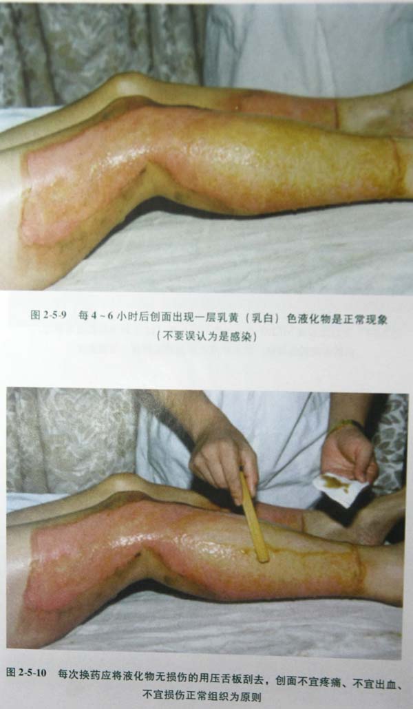 9170金沙集团_第二节 表皮深层损伤治疗手艺