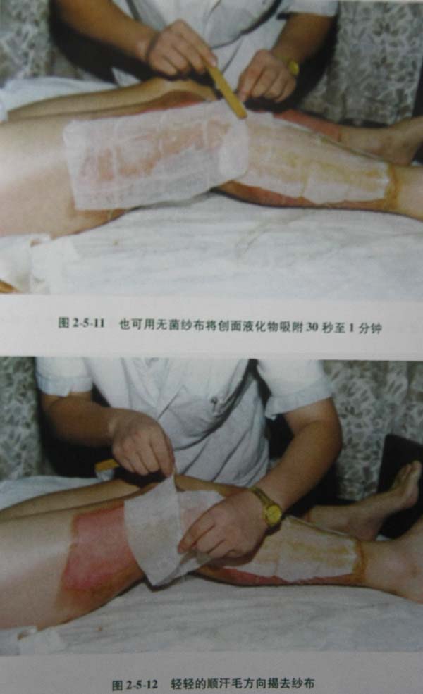 9170金沙集团_第二节 表皮深层损伤治疗手艺