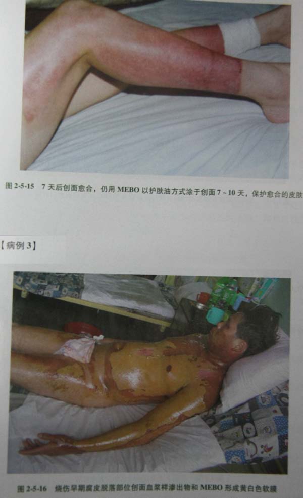 9170金沙集团_第二节 表皮深层损伤治疗手艺