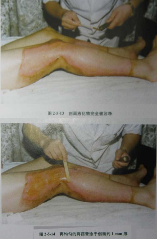 9170金沙集团_第二节 表皮深层损伤治疗手艺
