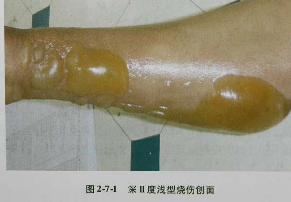 9170金沙集团_第一节 真皮浅层烧伤腐皮刮除减压术