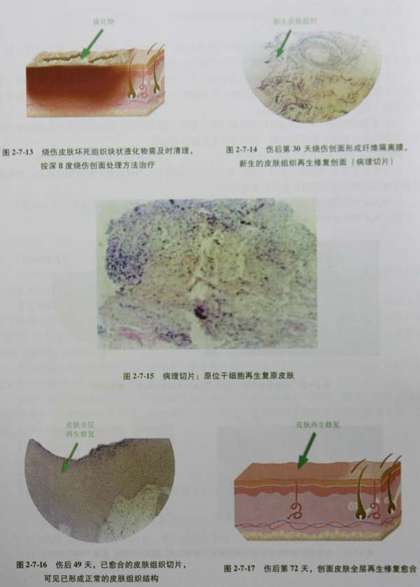 9170金沙集团_第四节 浅筋膜烧伤“格状”切开减压术