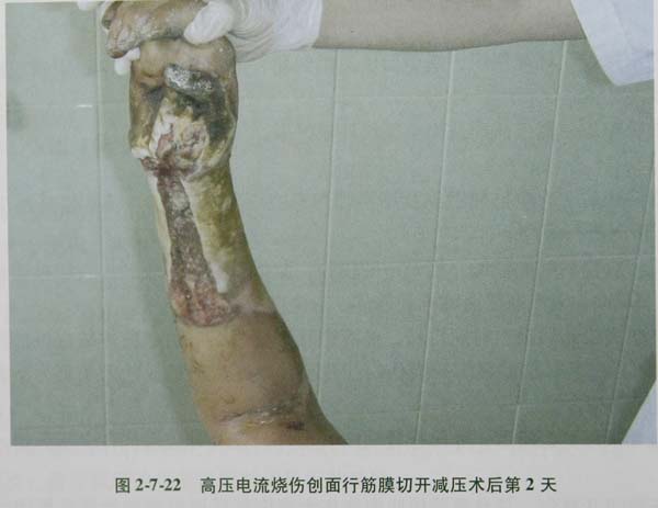 9170金沙集团_第六节 肌肉烧伤筋膜切开减压术