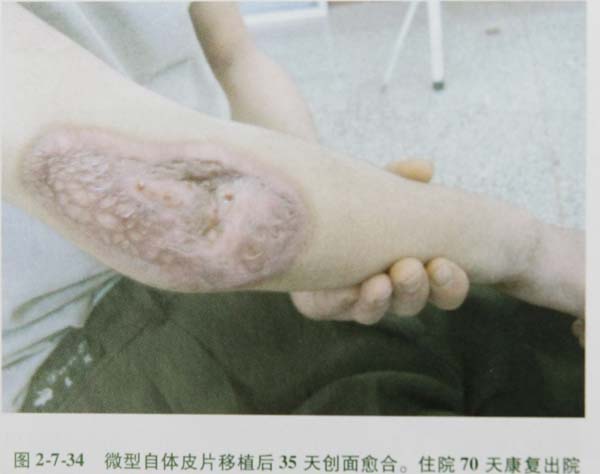 9170金沙集团_第七节 骨烧伤死骨凿除钻孔术