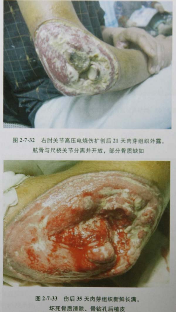 9170金沙集团_第七节 骨烧伤死骨凿除钻孔术