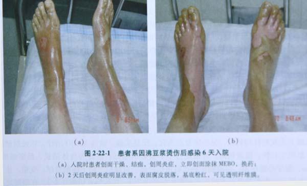 9170金沙集团_第五节 足部Ⅲ度深型烧伤治疗手艺