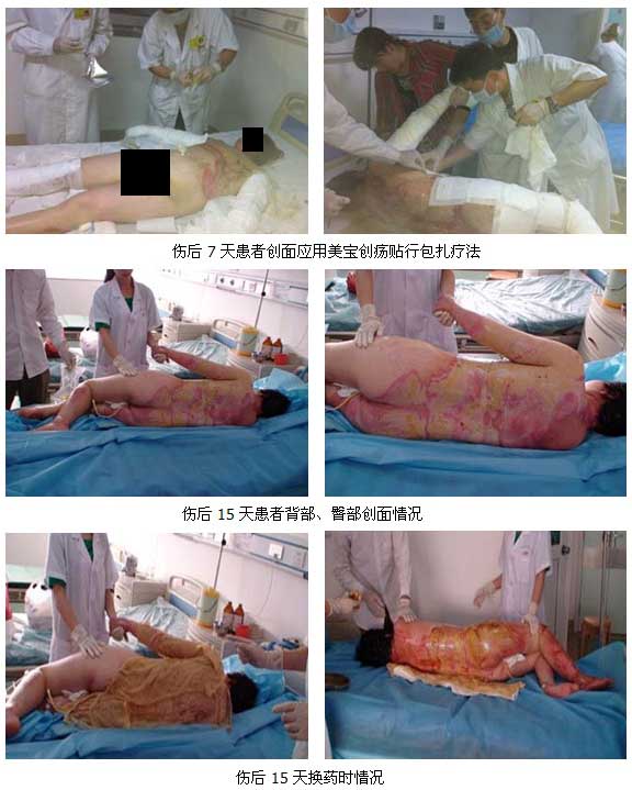 9170金沙集团_广西北海市中医院乐成救治一例大面积深度烧伤病人
