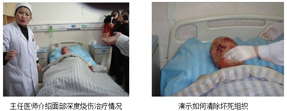 9170金沙集团_印度国家烧伤学会秘书长在四川深入相识和学习烧伤再生医学